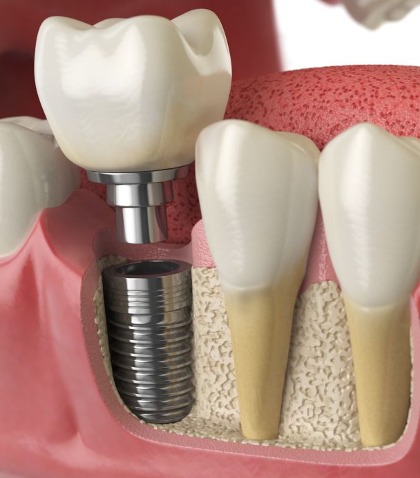 Dental implants service
