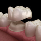 Dental Crowns in Mexico: