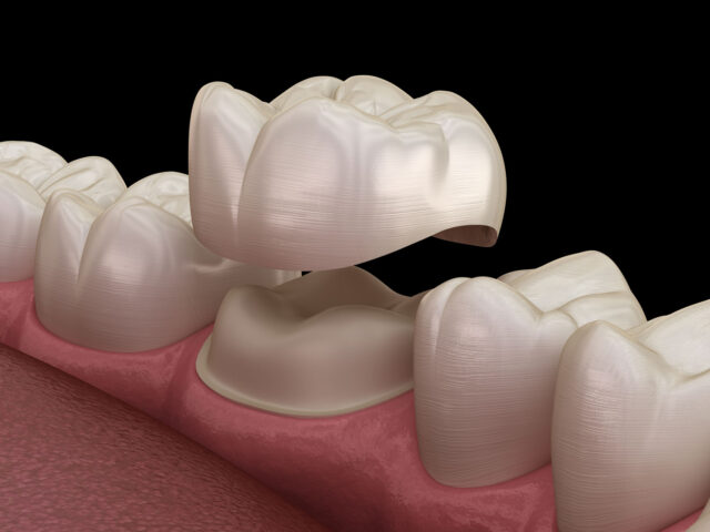How Long Do Implant Crowns Last?