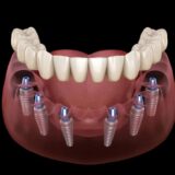 Titanium anchors used for All-on-6 dental implants in Cancun