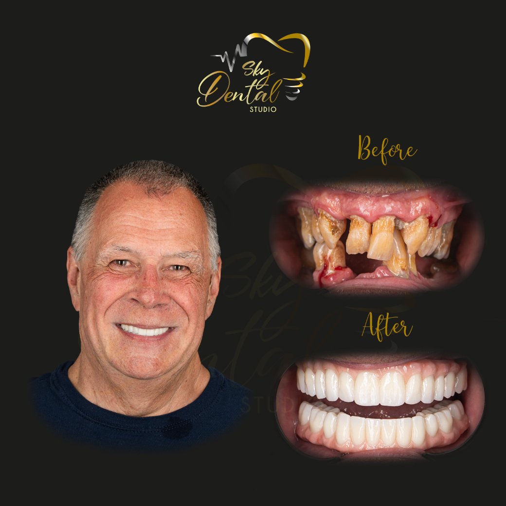 https://skydentalcancun.com/wp-content/uploads/2025/09/all-on-4-patient1-skydentalcancun-results.jpg