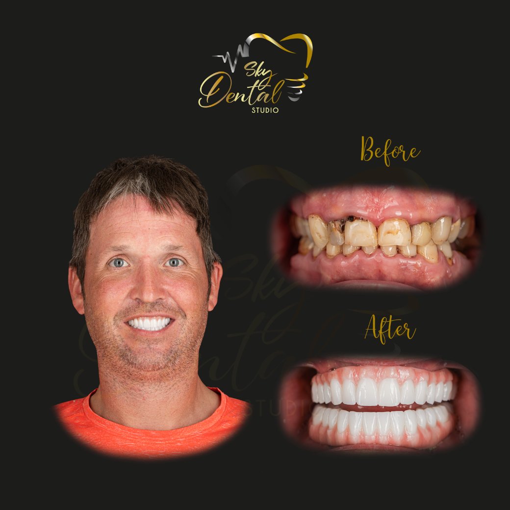 all-on-4-patient2-skydentalcancun-results