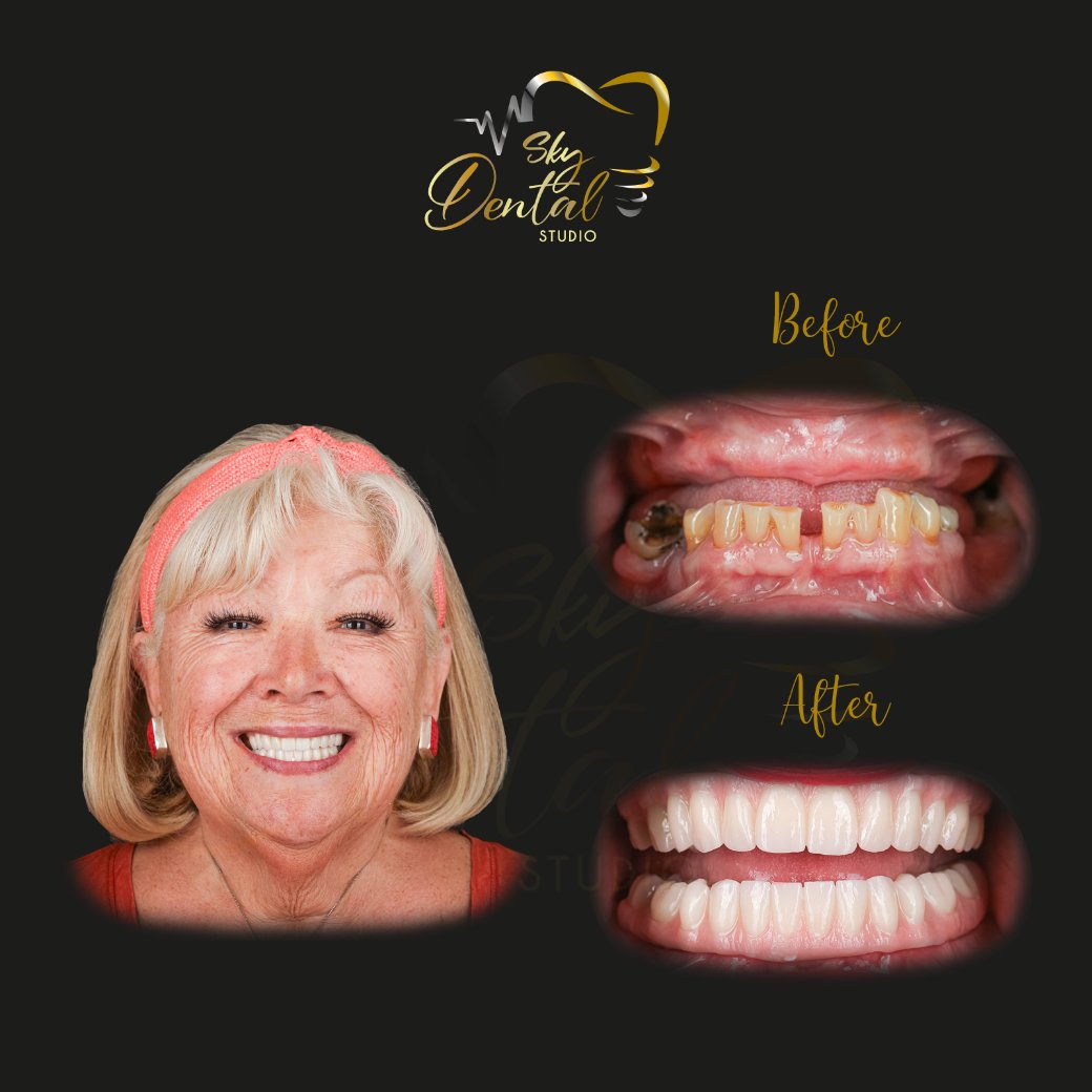 all-on-4-patient3-skydentalcancun-results