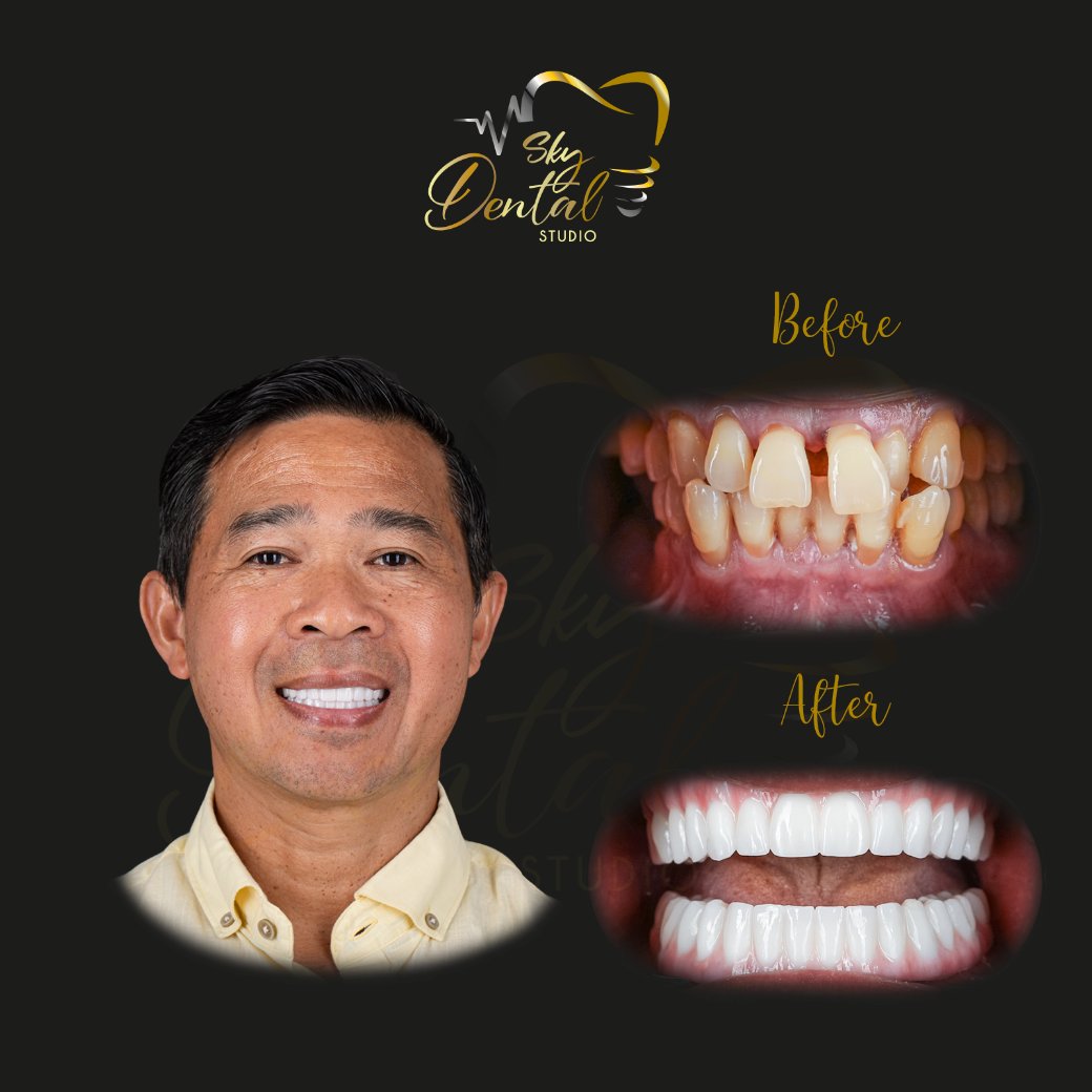 all-on-4-patient4-skydentalcancun-results