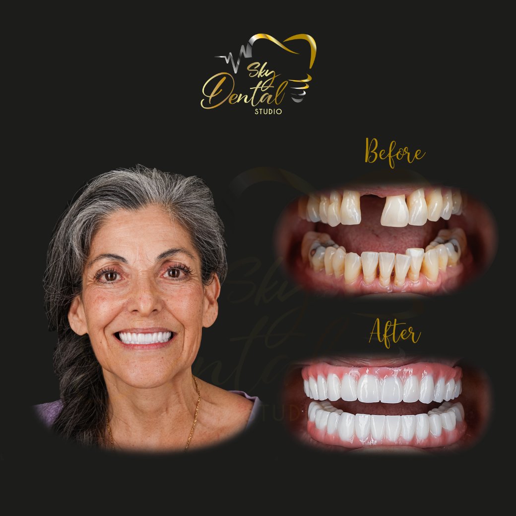 all-on-4-patient5-skydentalcancun-results