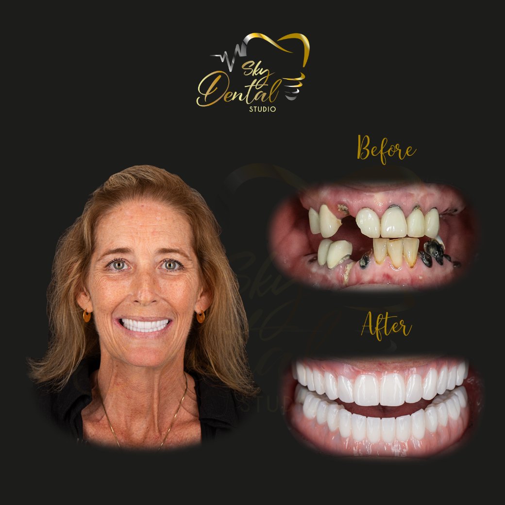 all-on-6-patient-1-skydentalcancun-results