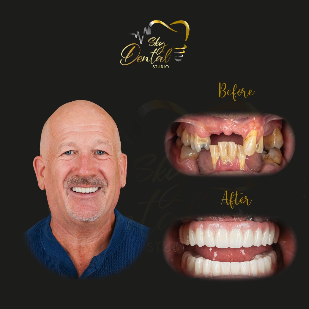 all-on-6-patient-2-skydentalcancun-results