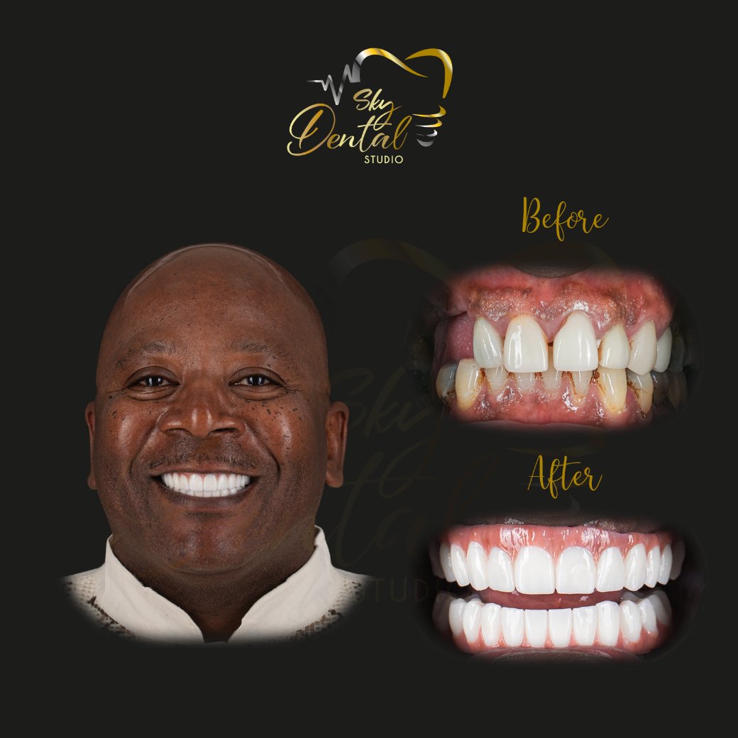 all-on-6-patient-4-skydentalcancun-results
