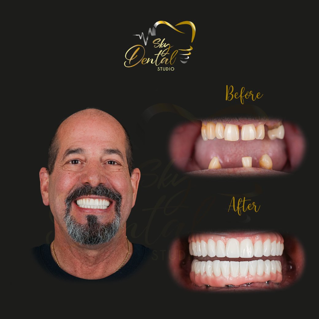 all-on-6-patient-5-skydentalcancun-results