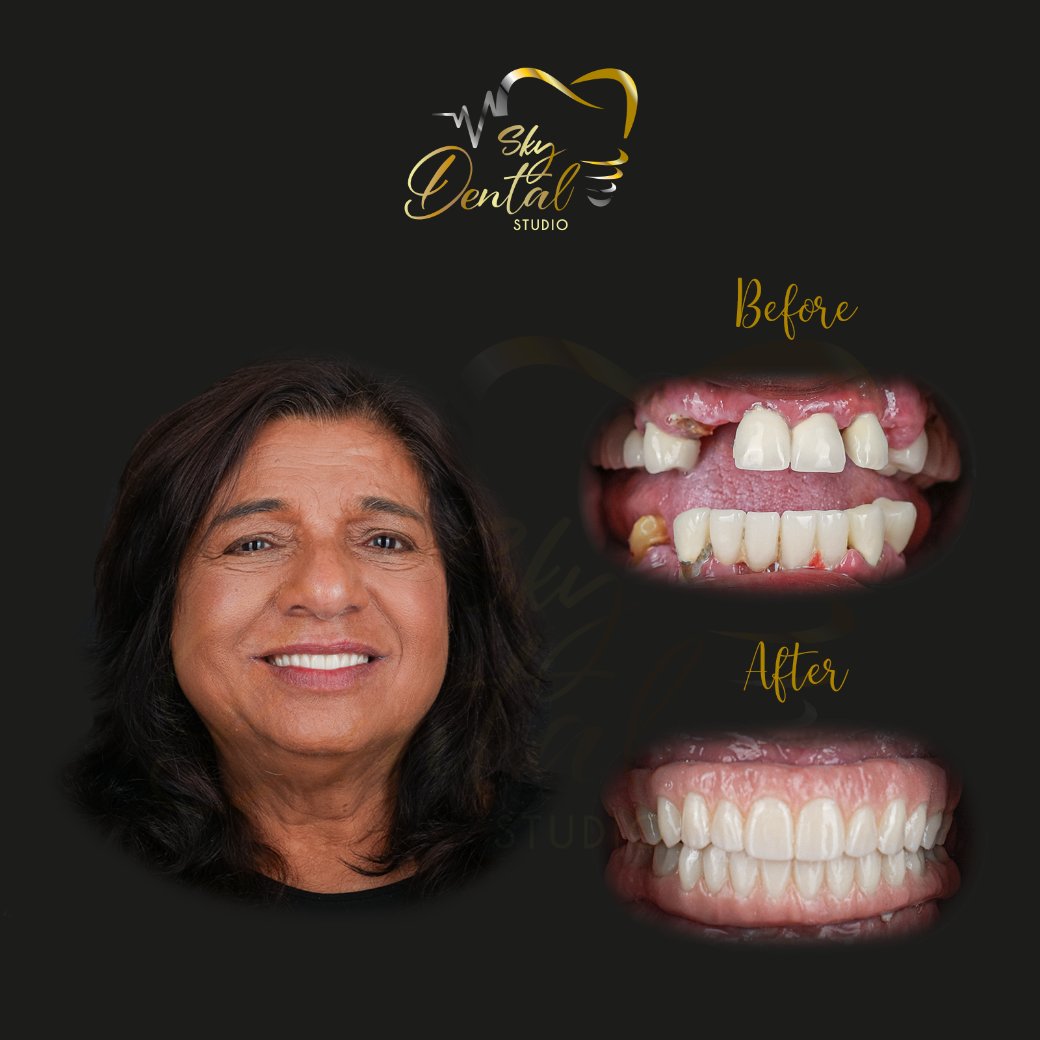 all-on-6-patient-6-skydentalcancun-results