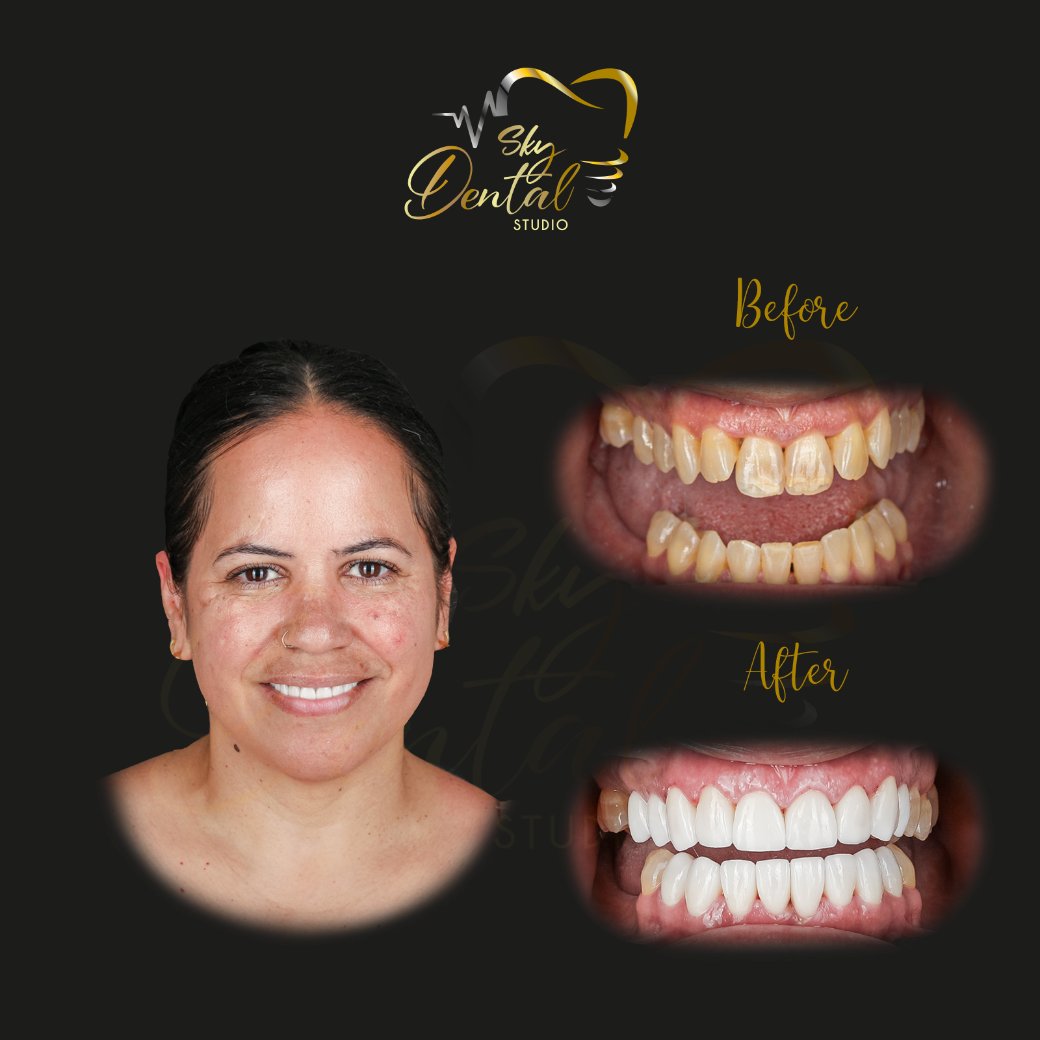 cosmetic-dentistry-patient2-skydentalcancun-results