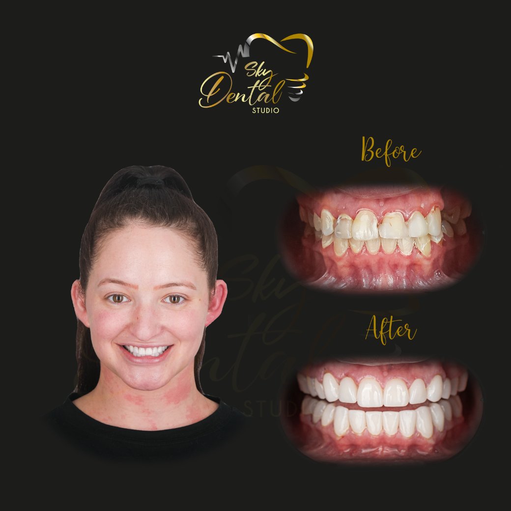 cosmetic-dentistry-patient3-skydentalcancun-results