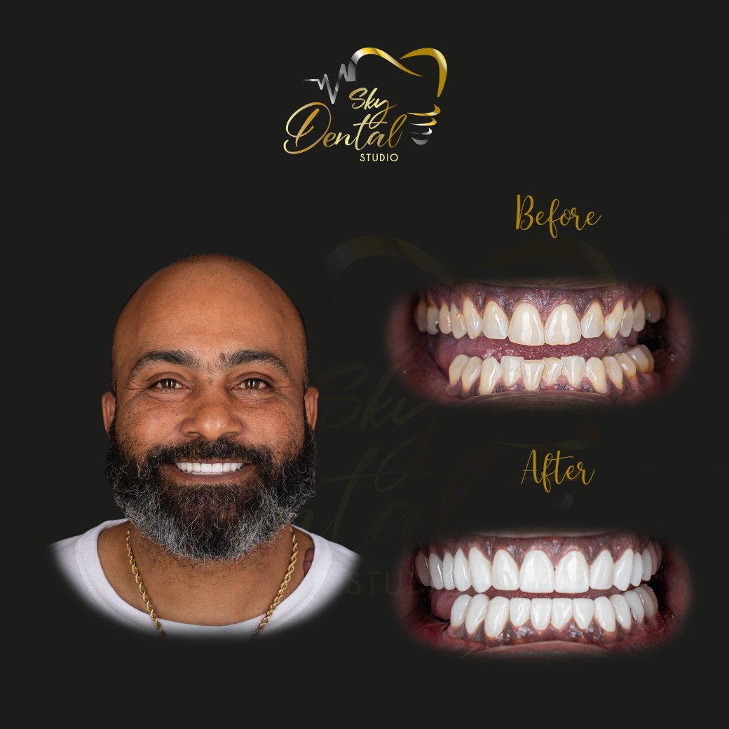 dental-crowns-patient1-skydentalcancun-results