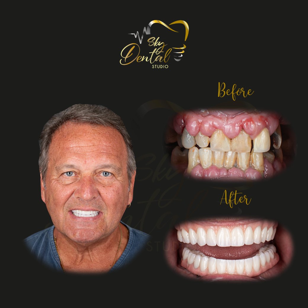 dental-crowns-patient3-skydentalcancun-results