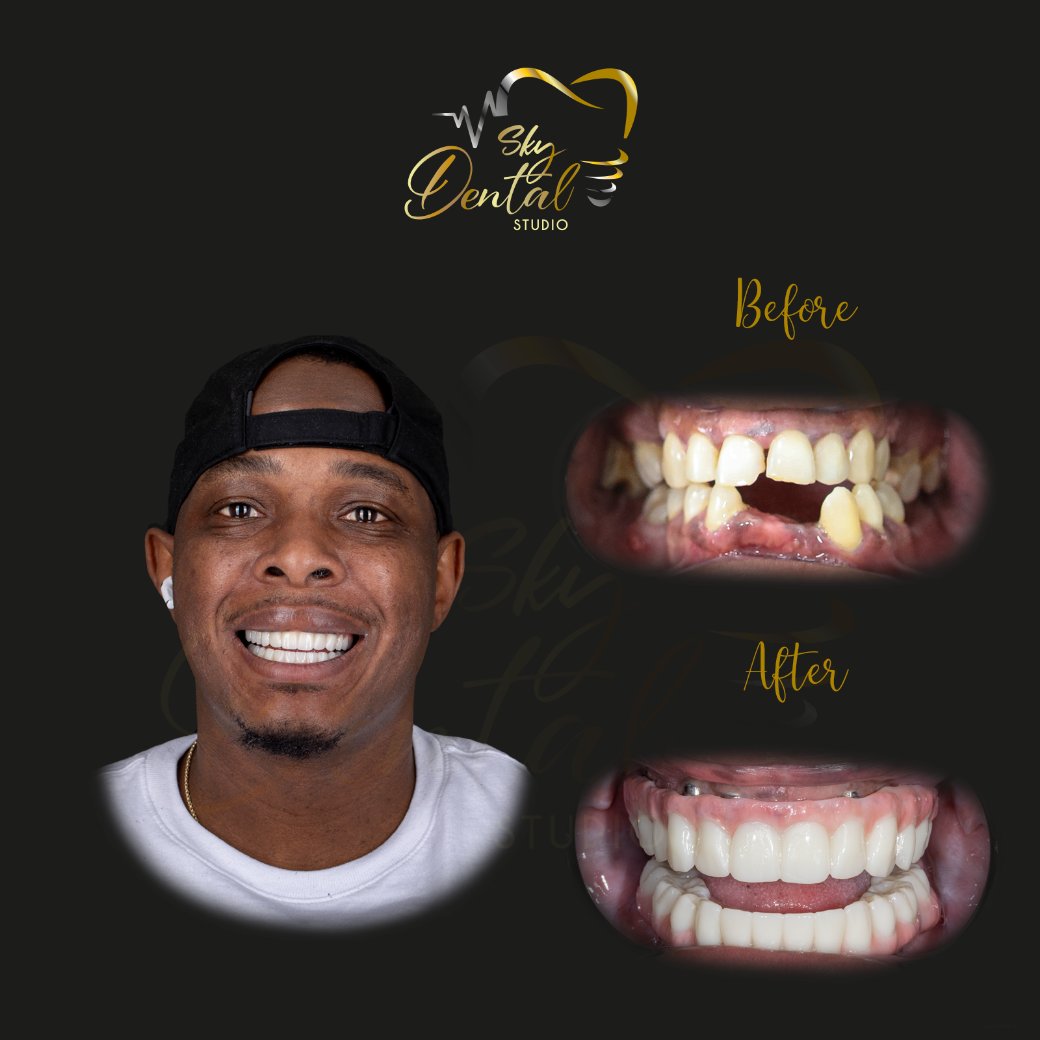 dental-implants-patient1-skydentalcancun-results