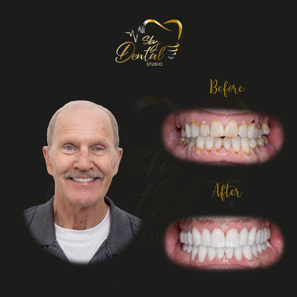 https://skydentalcancun.com/wp-content/uploads/2025/09/dental-implants-patient2-skydentalcancun-results.jpg