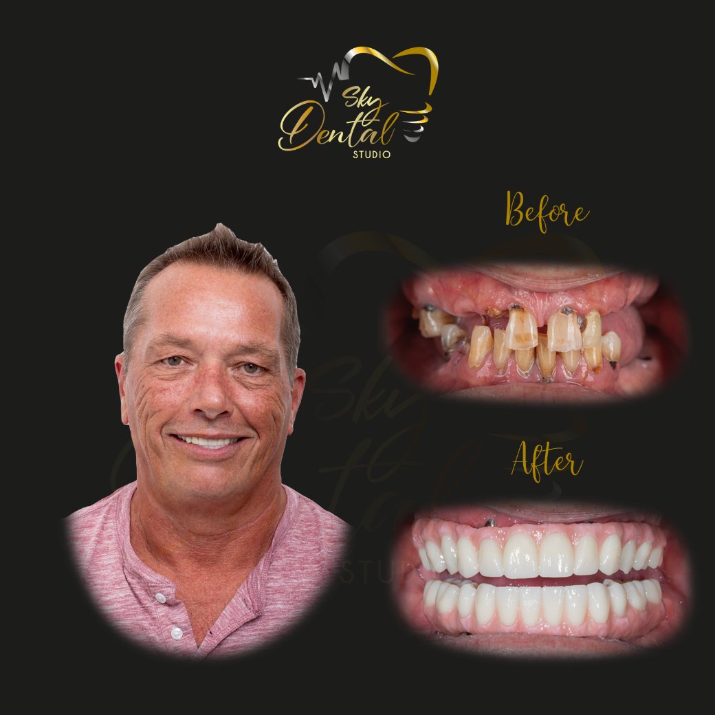 dental-implants-patient3-skydentalcancun-results