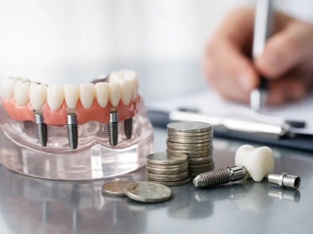 All-on-4 Dental Implants Cost Explained