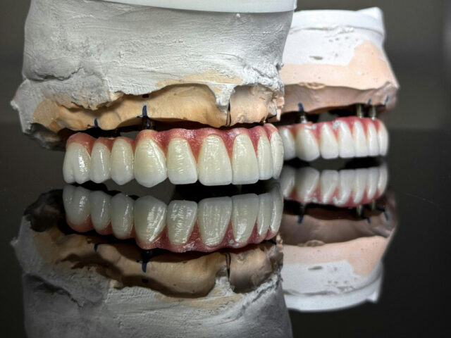 All-on-4 Dental Implants Pictures Explained
