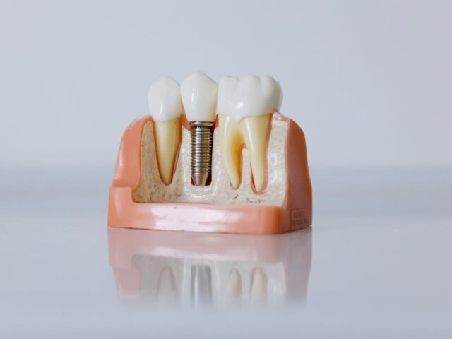How to Afford All-on-4 Dental Implants