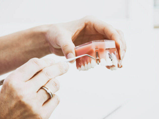 How to Care for All-on-4 Dental Implants