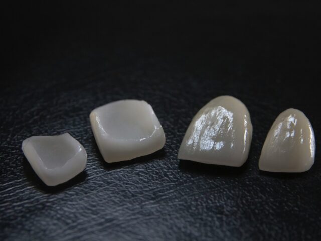 Veneers in Mexico Guide for Smart Patients