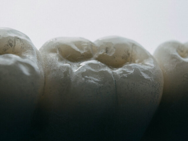 Dental Implants Cancun Mexico: What to Know