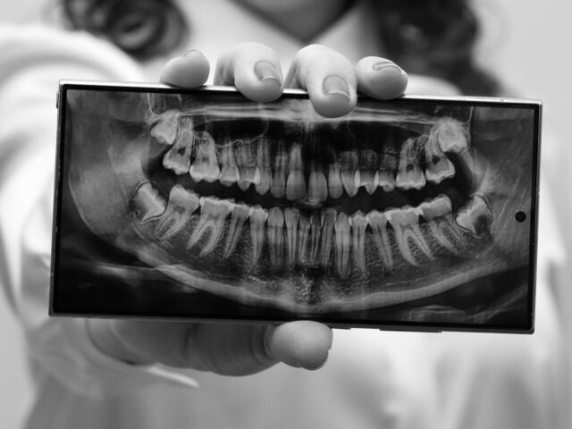 How to Prepare for Full Mouth Reconstruction