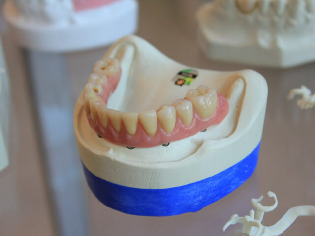 Implant Supported Dentures Explained