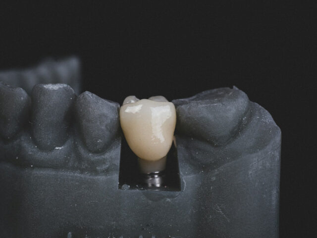 Dental Implants Guide for Confident Treatment