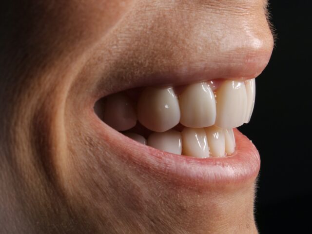 Full Arch Dental Implants Guide
